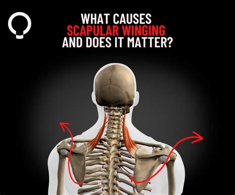 What Causes Scapular Winging And Does It Matter Functional Patterns