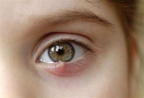 Stye In Childs Eye Types Causes Signs And Treatment