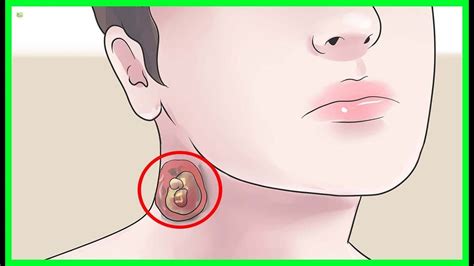 5 Effective Natural Remedies To Cure Sebaceous Cysts Best Home