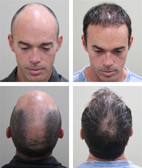 NeoGraft Photos Before And After Dr Michael McCracken