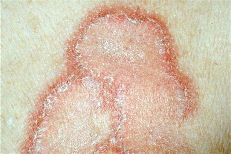 A psoriase é uma afecção de pele caracterizada por descamação epidérmica, provocada pela inflamação da derme, que se pode observar em todas as. Unaienses: Psoríase, doença que ataca a pele