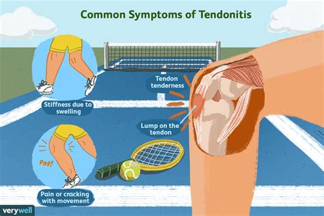 How Tendonitis Is Treated