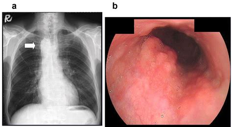 Successful Resection Of Esophageal Carcinoma Associated With Double
