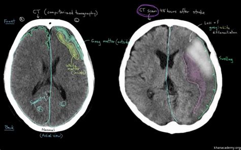 Read about diagnosing a stroke. stroke symptoms but clear mri Here's Why You Should Attend