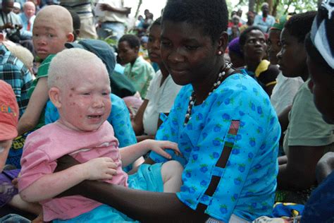 21 Persons With Albinism Killed In Malawi As Culture Of