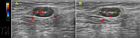 Frontiers Detection Of Inguinal Lymph Nodes Is Promising For The