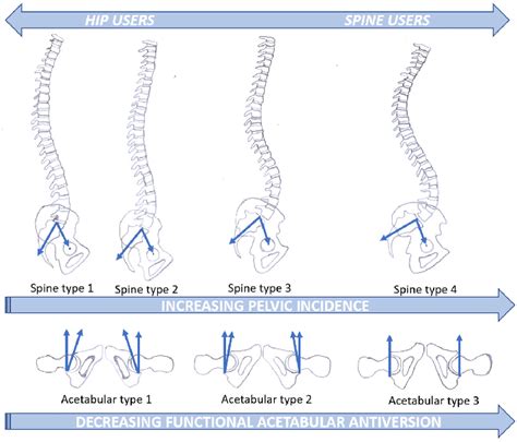 Four Types Of Spine Sagittal Alignment According To Roussouly