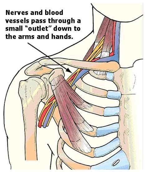 Thoracic Outlet Syndrome Treatment Innova Pain Clinic