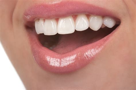 Enjoy The Benefits Of Instant Orthodontics With Porcelain Veneers