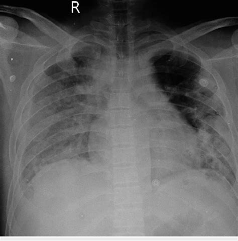 Chest X Ray Posteroanterior Pa View On Admission Suggestive Of