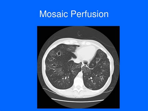 Ppt Chest Radiology Plain Film And Ct Beyond The Basics Powerpoint