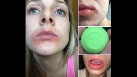 Class Action Lawsuit Eos Lip Balm Causes Severe Blisters Rashes