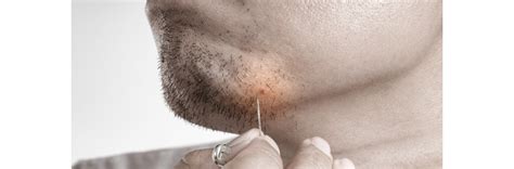 How To Prevent And Treat Ingrown Hair Esses Editorial Laser Hair