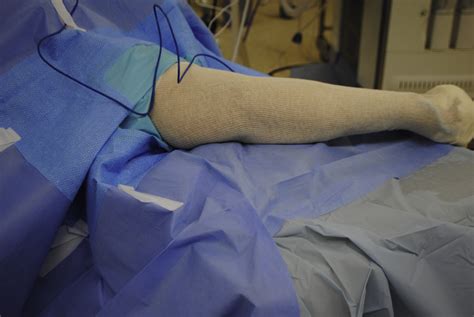 Endoscopic Robotic Decompression Of The Ulnar Nerve At The Elbow