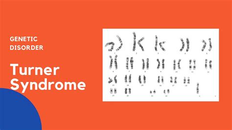 Turner Syndrome Symptoms Causes Diagnosis And Treatment