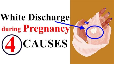 Causes For White Discharge During Pregnancy In Second Trimester Youtube