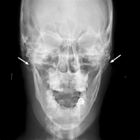 Pdf Diagnosis Of Jaw And Dentoalveolar Fractures In A Traumatized