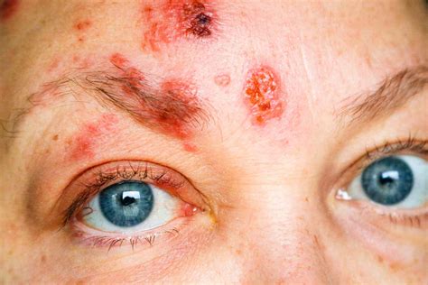 Pictures Of Shingles On Your Face Itiscouragethatcounts