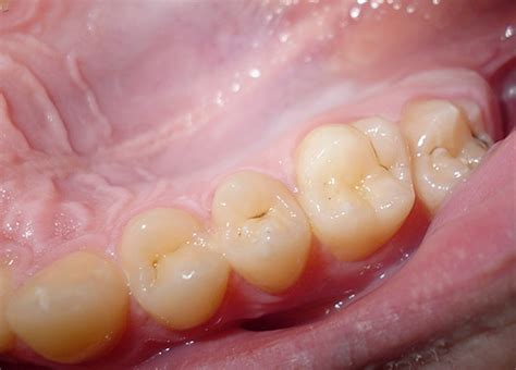 Die initialkaries beginnt in der oberen zahnschmelzschicht mit entkalkungen. Initialkaries und ihre Behandlung (Stadien von weißen bis ...