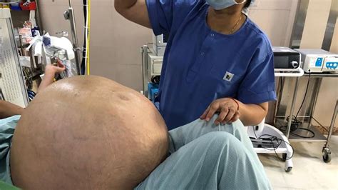 Huge Ovarian Tumour Weighing Almost 8 Stone Removed From 52 Year Old
