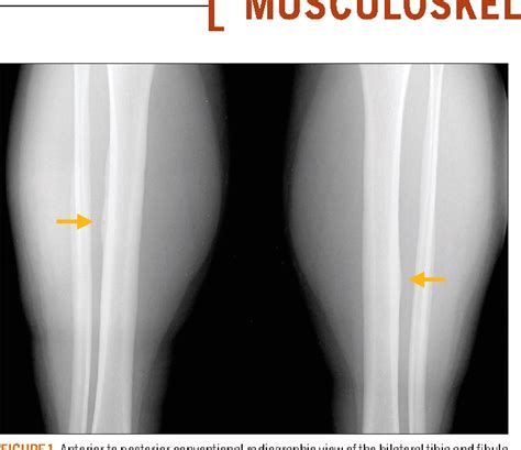 Figure 1 From Identification Of A High Risk Anterior Tibial Stress