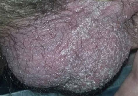 This, in turn, causes ingrown hair which causes skin bumps and irritation. Scrotal Ingrown Hair Symptoms, Pictures, Symptoms, Cyst ...