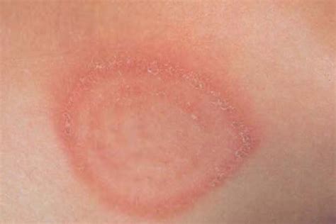 Common Skin Rashes On Children