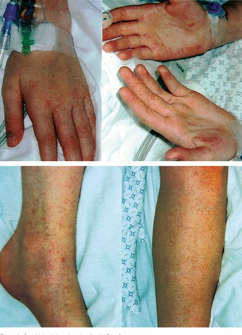 Figure 1 From Fever And Petechial Rash Associated With Parvovirus B19