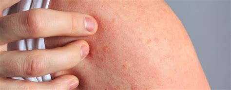 ¿cuál Es La Diferencia Entre Eczema Y Dermatitis Atópica Medstetic