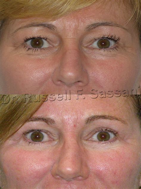 Before After Of A Eyelid Surgery PlasticSurgery Surgery Plastic Surgery