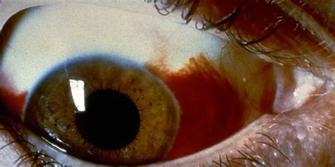 What Is A Subconjunctival Hemorrhage American Academy Of Ophthalmology