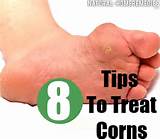 Home Remedies Corn Removal Photos