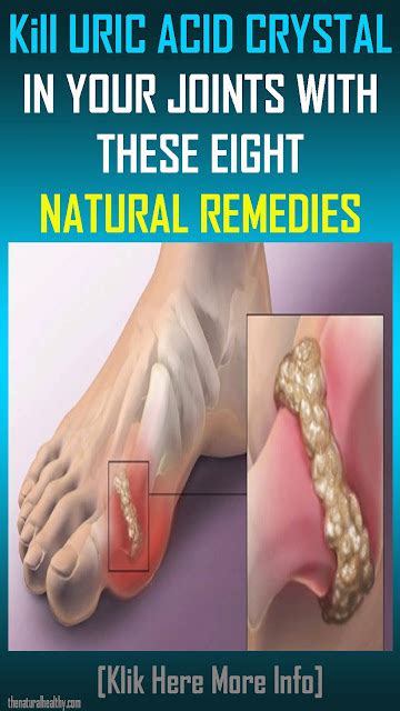 Kill Uric Acid Crystal In Your Joints With These Eight Natural Remedies