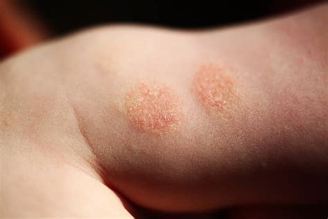 130 Nummular Eczema Stock Photos Pictures And Royalty Free Images Istock