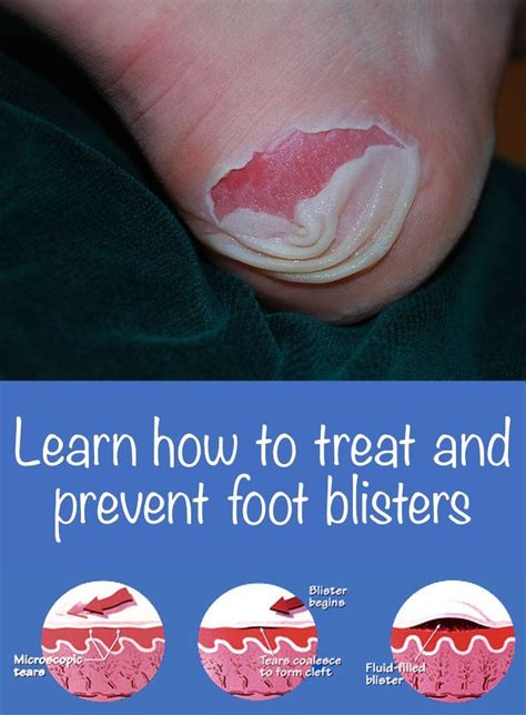 How To Treat And Prevent Foot Blisters Home Health Remedies Blister