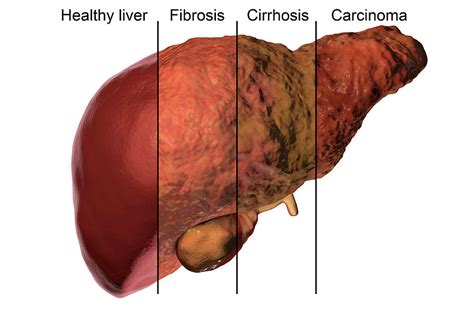 Stages Of Liver Disease 2 Photograph By Kateryna Kon Science Photo Library Pixels