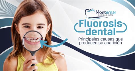 Fluorosis Dental La Cara B Del Exceso De Flúor Sobre Tus Dientes