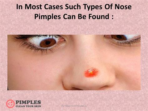 How To Get Rid Of Nose Pimples Fast Youtube