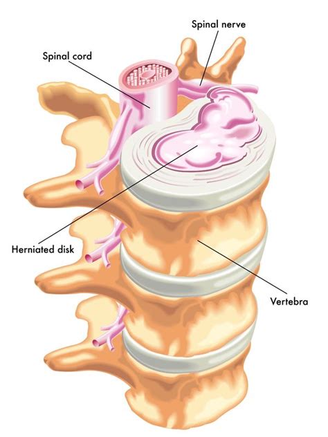The most annoying symptoms of this condition are the lower back pain due to lumbar herniated disc, sometimes referred to as buttocks and legs. Herniated Discs and Bulging Discs | What's the Difference ...