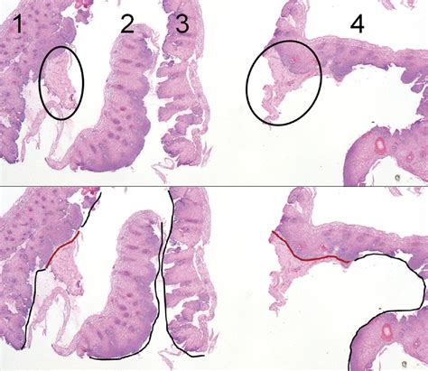Adequacy Of Esophageal Squamous Mucosa Specimens Obtained During