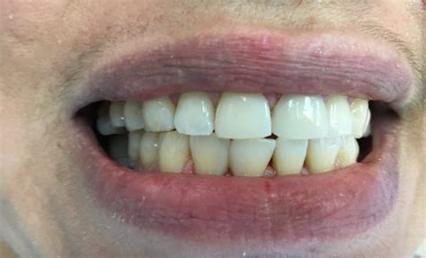 Close Gap In Front Teeth In One Visit Without Braces Menlo Park Dental