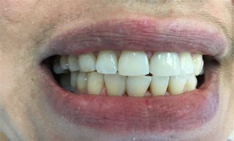I have a problem of my front two teeth. Close Gap In Front Teeth In One Visit Without Braces ...