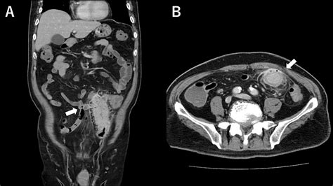 Cureus Sigmoid Colon Cancer Masked By Refractory Diverticulitis With
