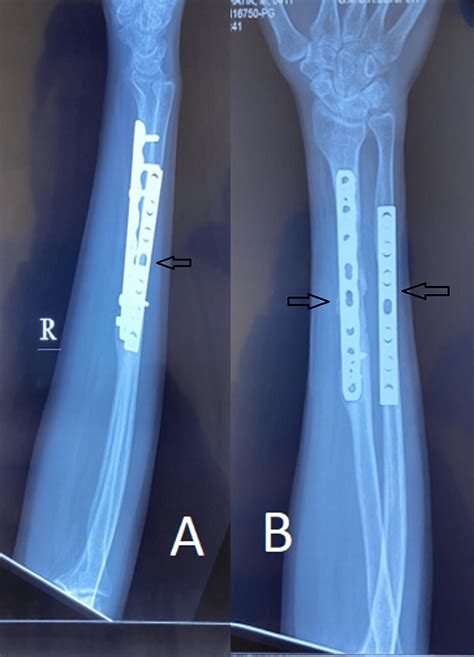 Cureus A Comparative Study Between Plate Osteosynthesis And