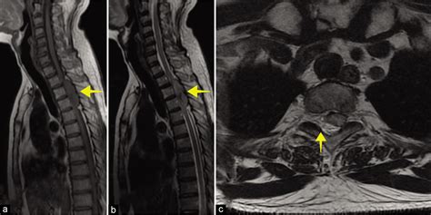 Extradural Malignant Peripheral Nerve Sheath Tumor Of The Thoracic