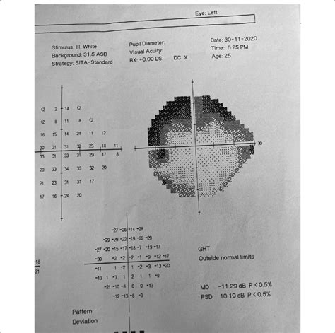 Perimetry Of The Left Eye Showing Superior Temporal And Nasal Arcuate