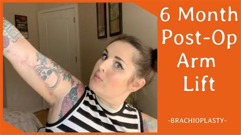 6 Month Post Op Arm Lift Brachioplasty Youtube