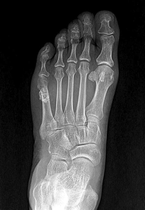 Foot Anteroposterior Radiograph Showing A Calcification Over The 5th