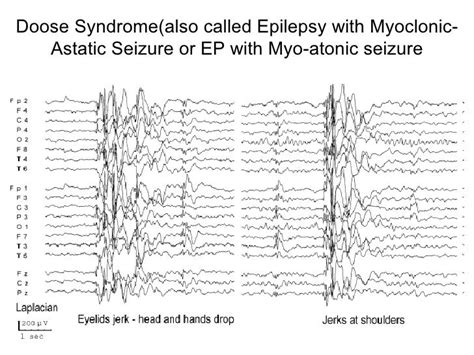 Epilepsy