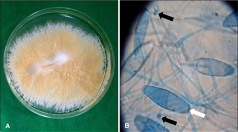 Pdf A Case Of Kerion Celsi Caused By Microsporum Gypseum In A Boy